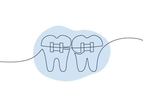 Two teeth with braces connected by a dental floss line, all within a blue irregular shape, illustrating dental care and hygiene.