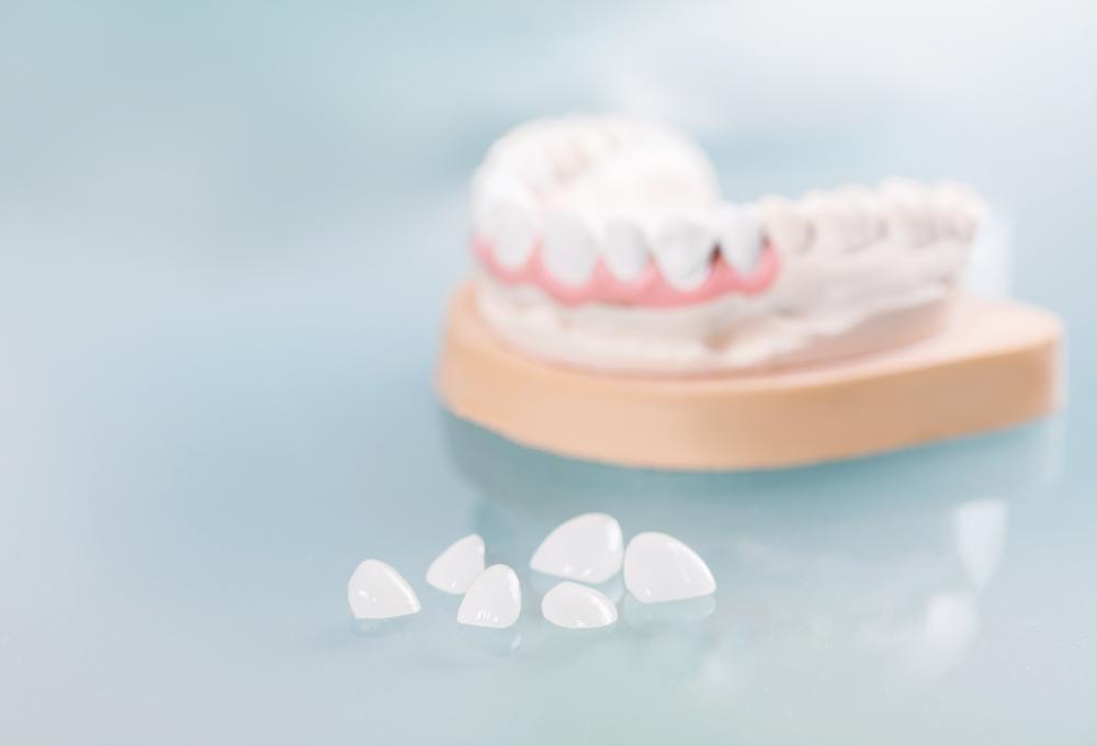 Dental model and veneers on a reflective surface, showcasing tooth restoration materials in a clinical setting.