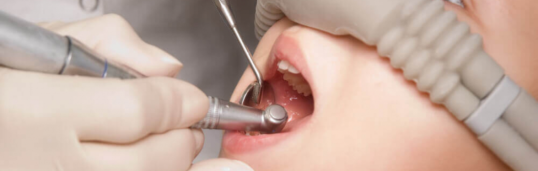 Laughing Gas & Dental Procedures
